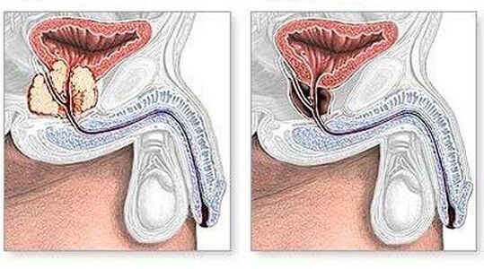 Before and after the treatment of chronic surgically prostatitis