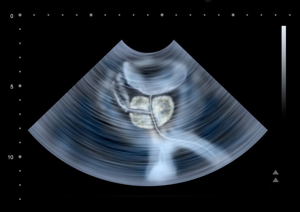 prostatic diagnostics